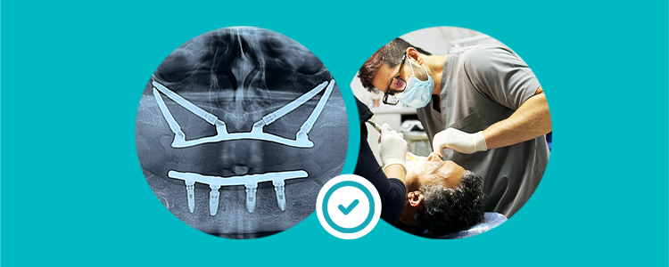 implantes zigomáticos